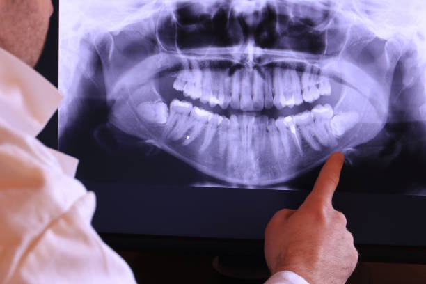Best Emergency Wisdom Teeth Removal in Healdsburg, CA
