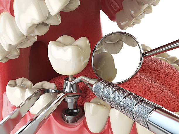 Best Emergency Tooth Extraction in Healdsburg, CA