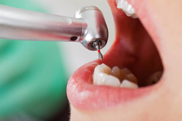 Best Emergency Dental Care for Broken or Chipped Teeth in Healdsburg, CA